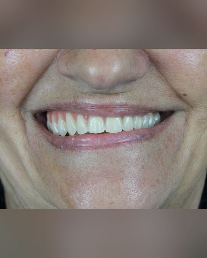 Resultado: Protocolo sobre implantes