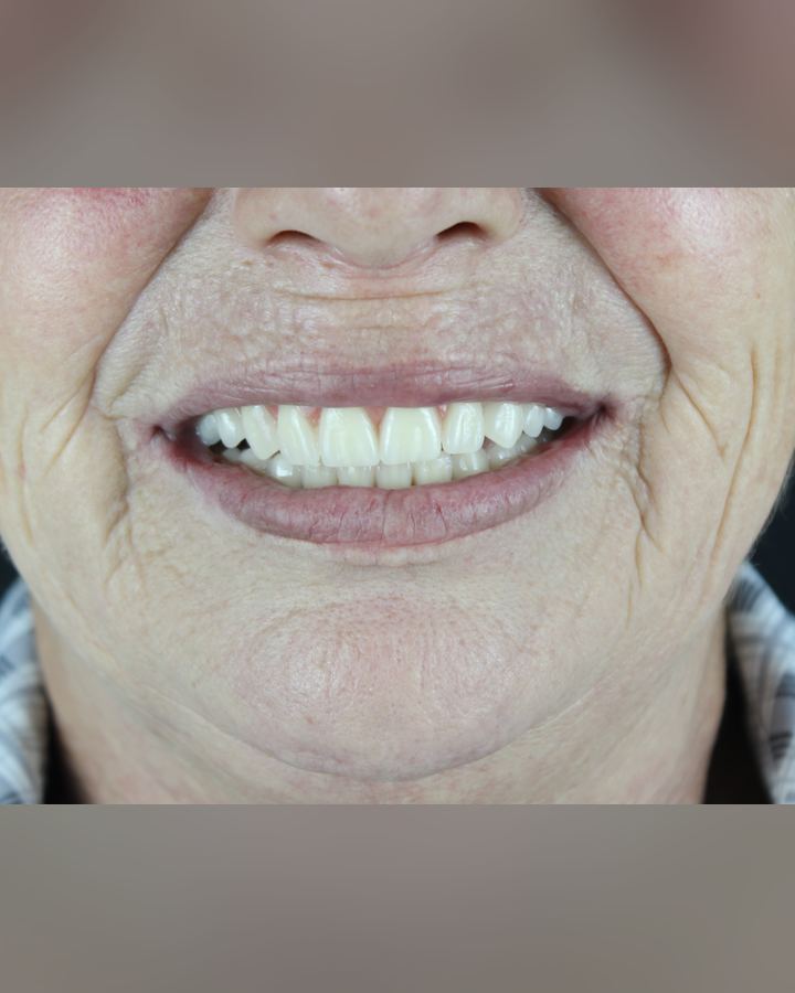 Resultado: Protocolo sobre implantes