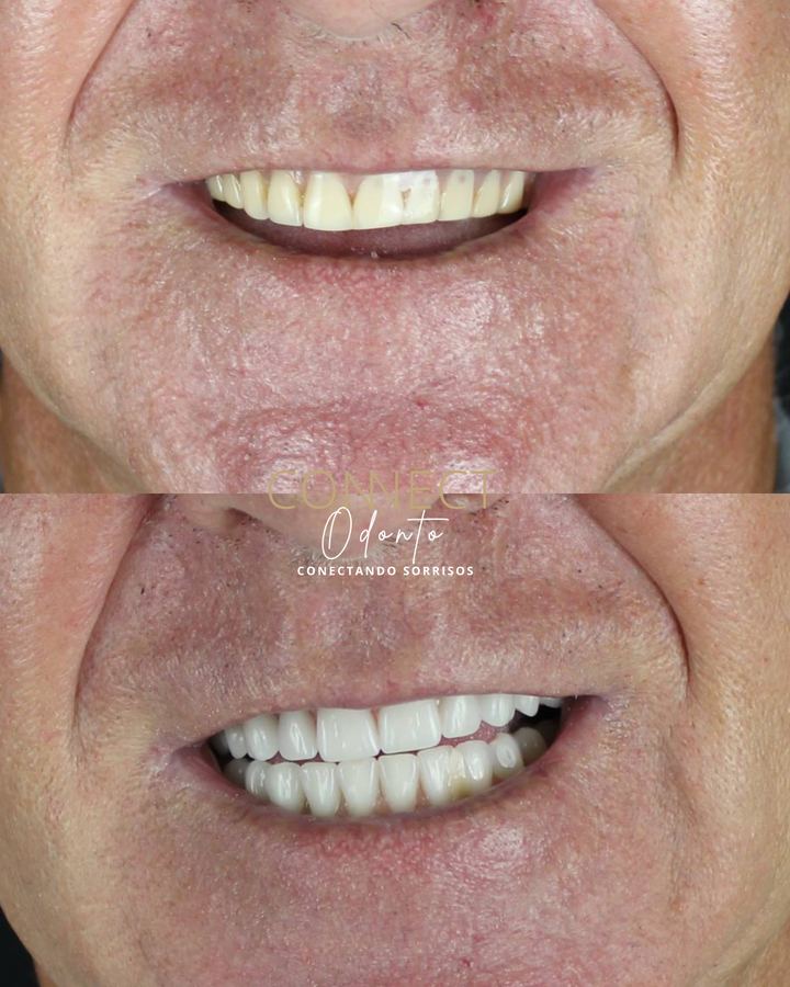 Antes e depois: Protocolo sobre implantes