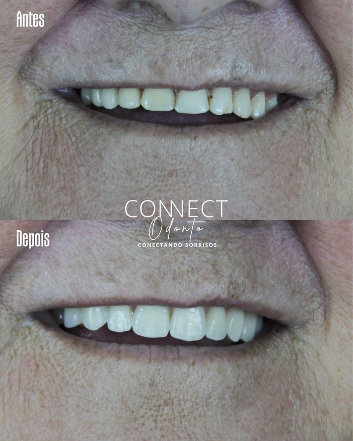 Antes e depois: Prótese e protocolo